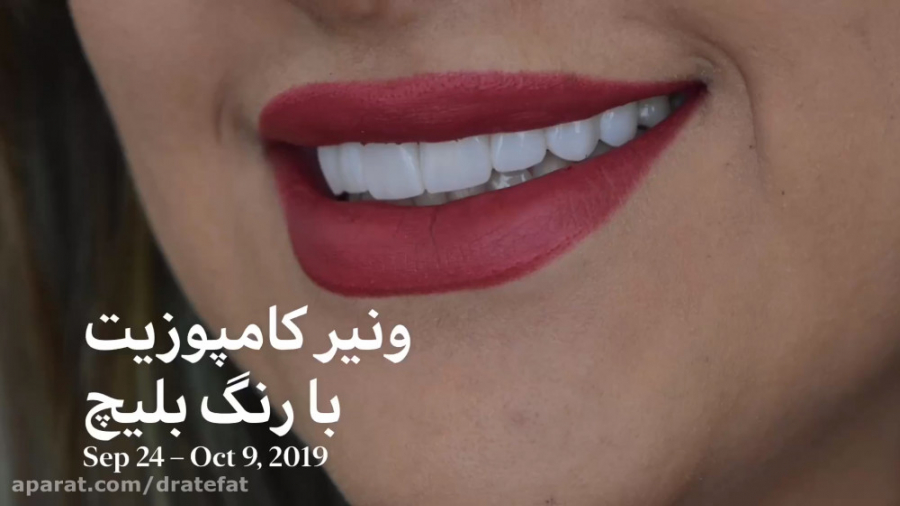 ونیر کامپوزیت دندانهای فک بالا با رنگ بلیچ دکتر محمد عاطفت متخصص ترمیمی و زیبایی اصفهان