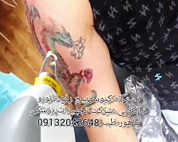 قویترین دستگاه رفع تاتو وخالکو...