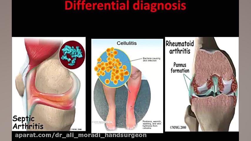عفونت حاد استخوان (َAcute Osteomyelities Disease) دکتر علی مرادی جراح دست