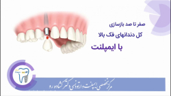 صفر تا صد بازسازی کل دندانهای فک بالا با ایمپلنت کلینیک دندانپزشکی دکتر عزیز گشاده رو