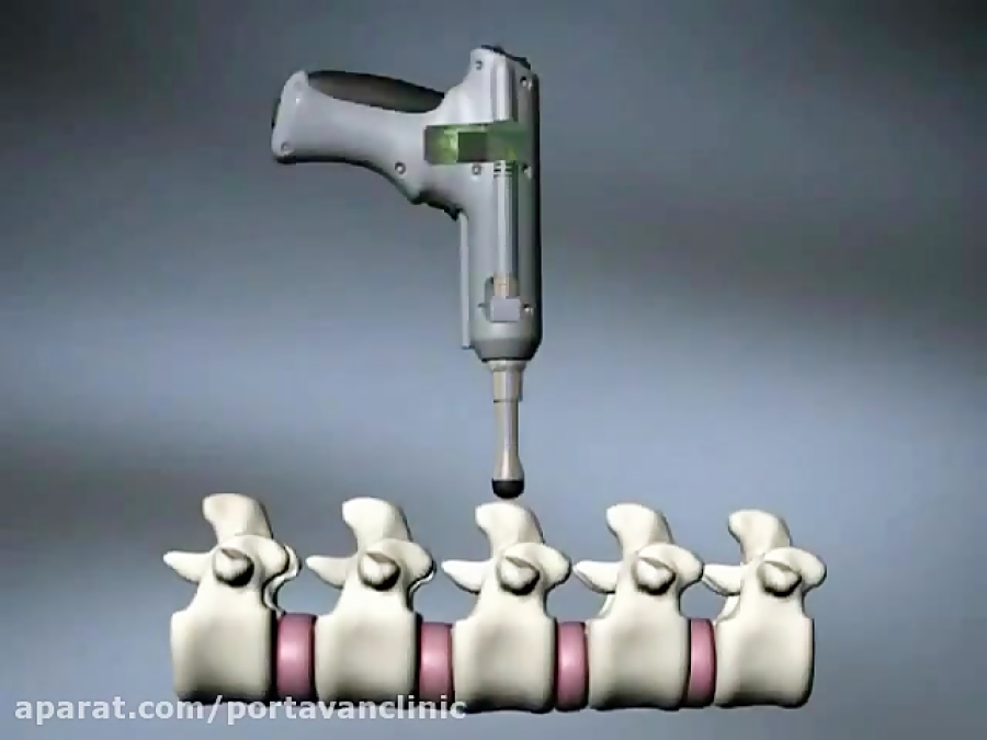 فیزیوگان . درای نیدل - فیزیوتراپی- دکتر فیزیوتراپی