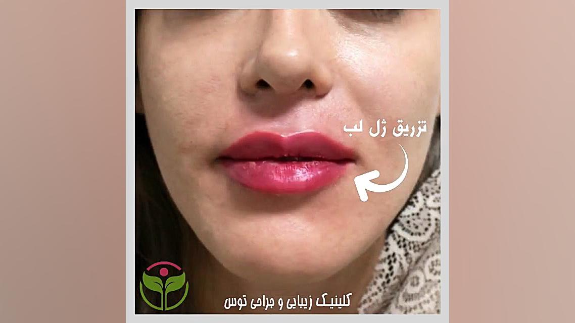 تزریق ژل لب در کلینیک توس کلینیک دندانپزشکی