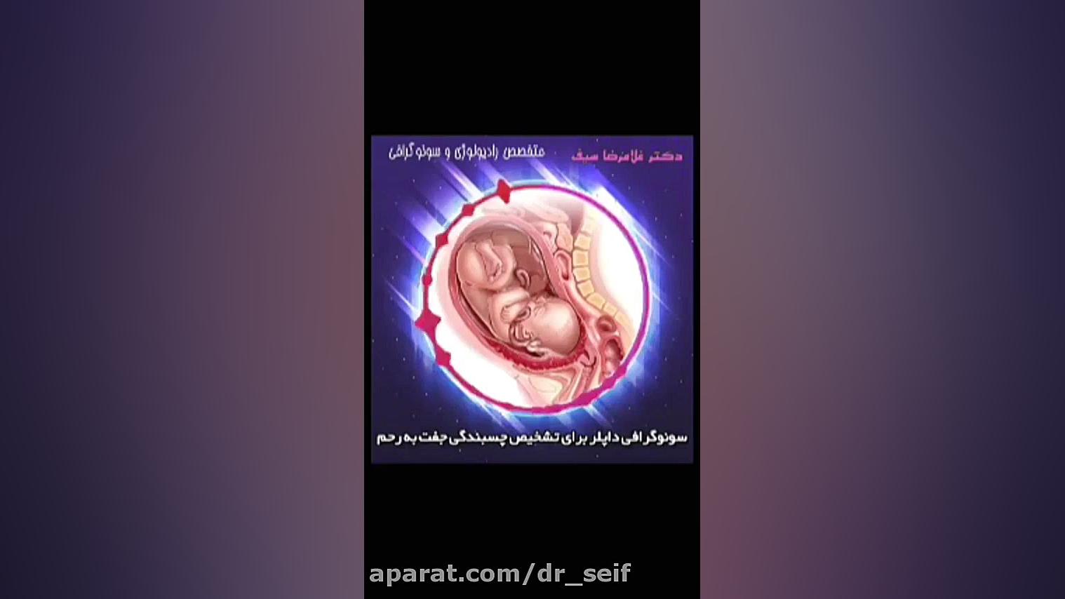 چسبندگی داپلر برای تشخیص چسبندگی جفت به رحم جرمگیری