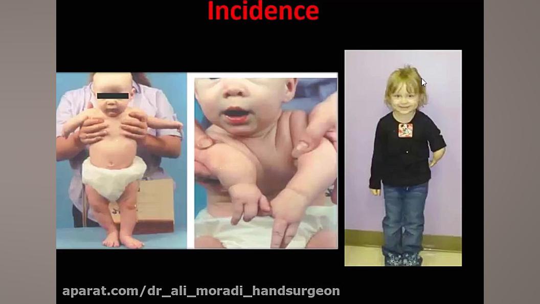 Congenital Anomalies Disease-1(آنومالی اندام فوقانی) دکتر علی مرادی جراح دست