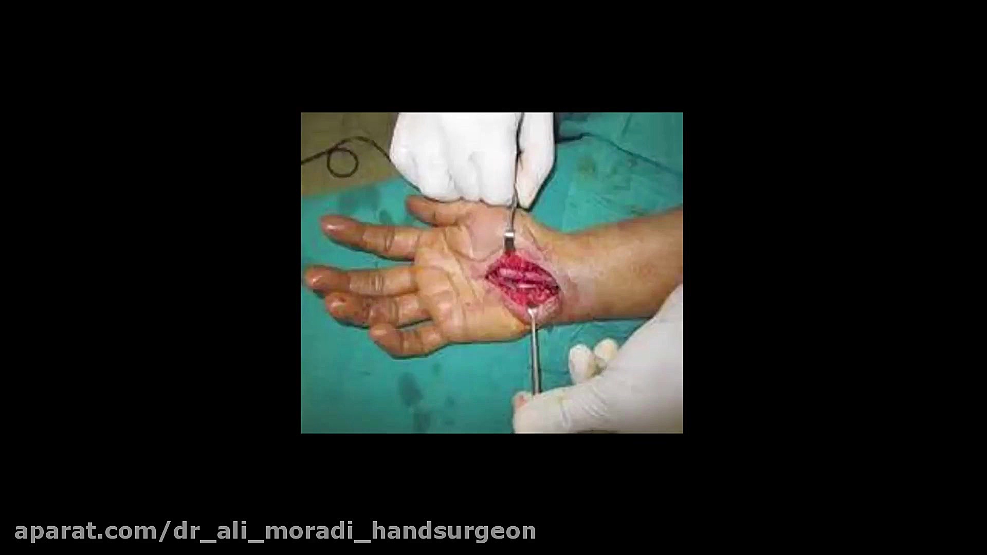 Congenital Anomalies Disease-1 (سندرم تونل کارپ) دکتر علی مرادی جراح دست