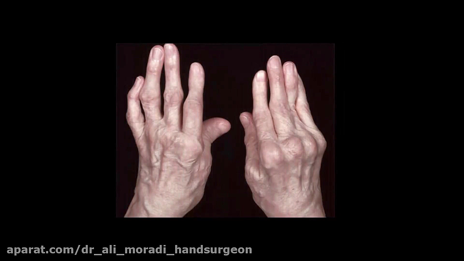 De Quervain Disease-1 دکتر علی مرادی جراح دست