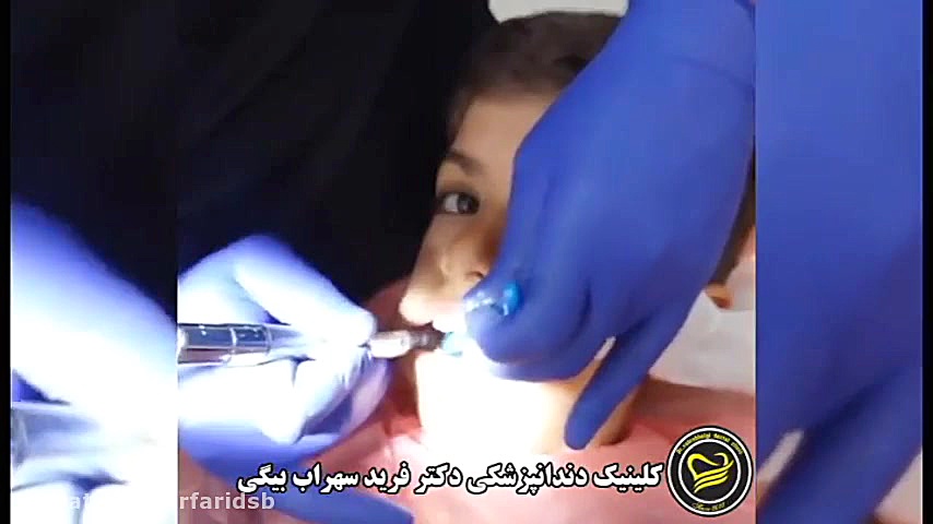 پالپکتومی (عصب کشی اطفال) کلینیک دندانپزشکی دکتر فرید سهراب بیگی