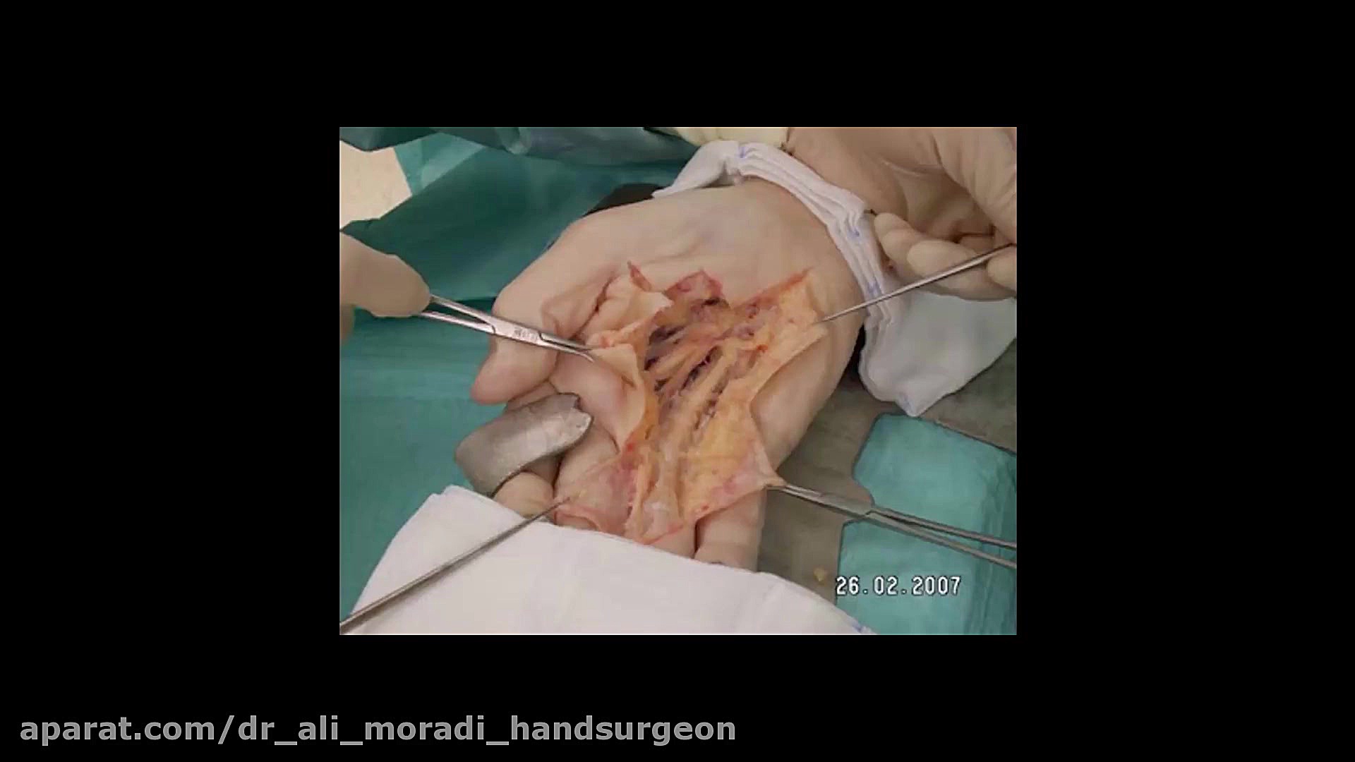 Dupuytren Disease-1 دکتر علی مرادی جراح دست