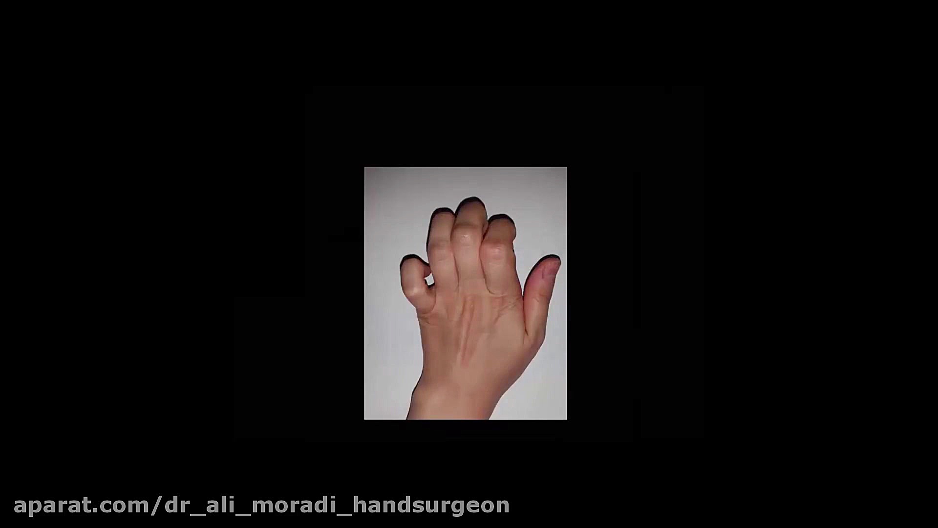 Extensor Tendon's Disease-1 دکتر علی مرادی جراح دست
