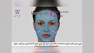 درمان آکنه با میکرونیدلینگ TWA