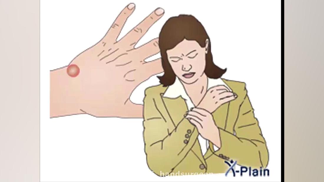 Ganglion Cyst Disease-1 دکتر علی مرادی جراح دست