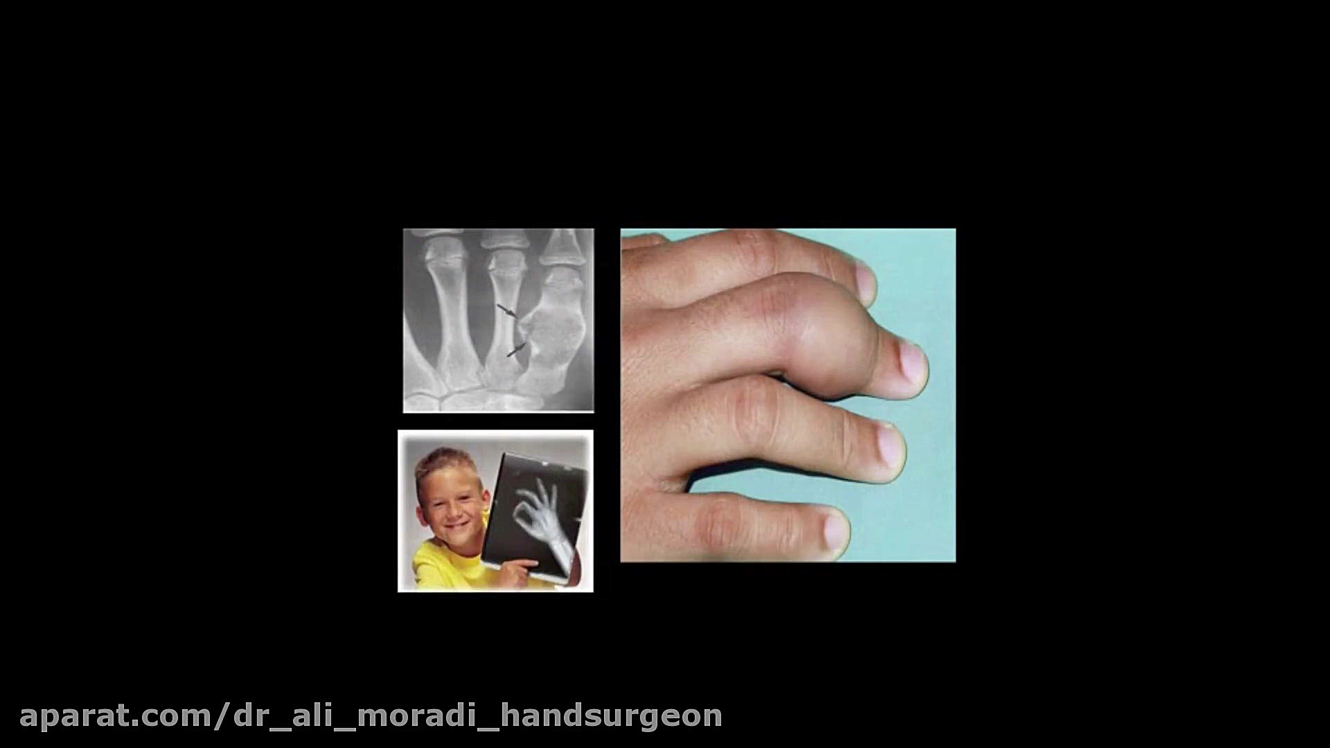 (تومور های دست) Hand Tumors Disease-1 دکتر علی مرادی جراح دست