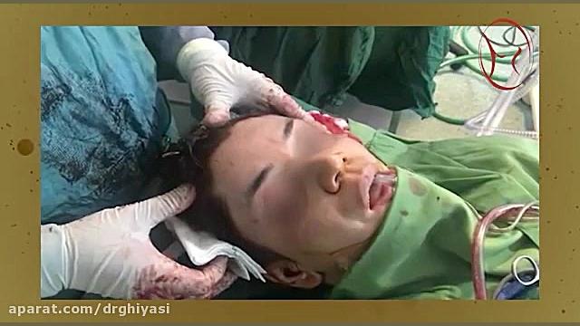 لیفت ابرو RF Test