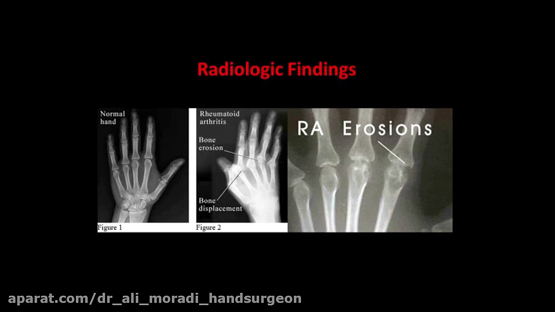 Rheumatoid Hands' Disease-1 دکتر علی مرادی جراح دست