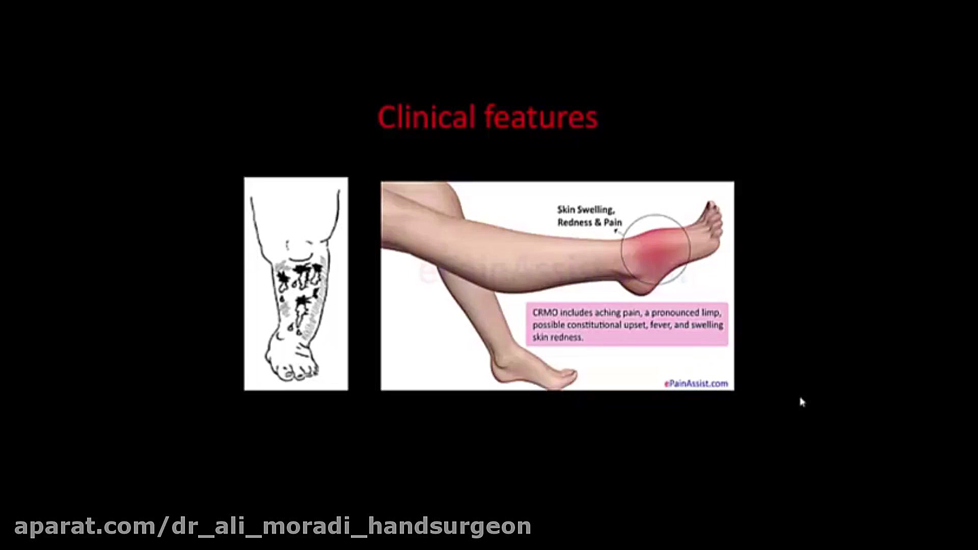 Subacute And Chronic Osteomyelities Disease-1 دکتر علی مرادی جراح دست