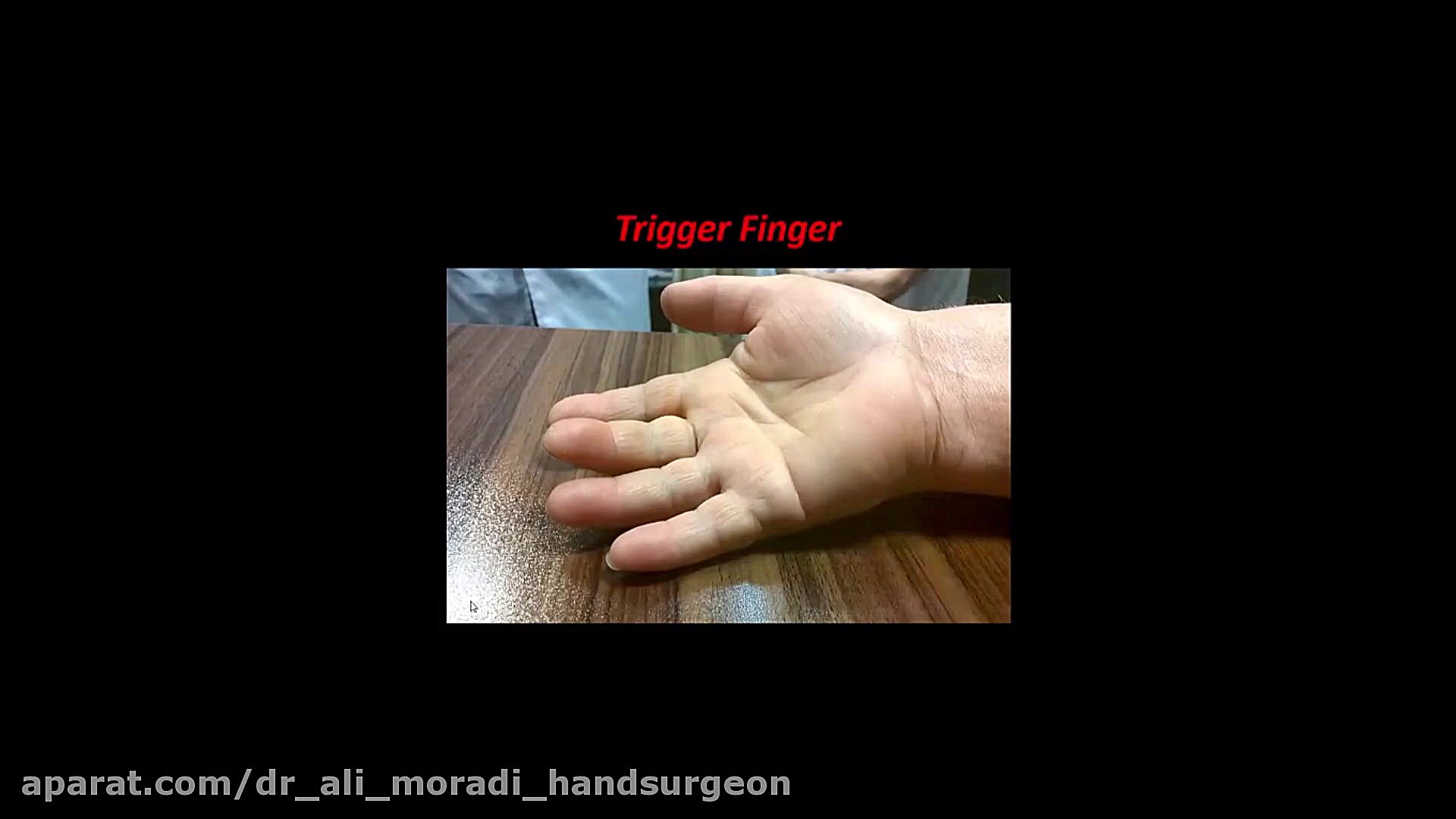 (انگشت ماشه ای) Trigger Disease دکتر علی مرادی جراح دست