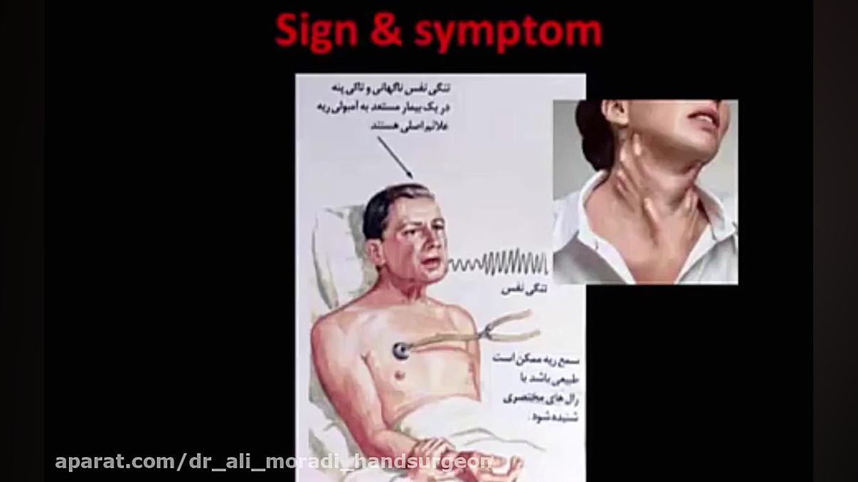 Vte Disease (Venous thromboembolism) دکتر علی مرادی جراح دست