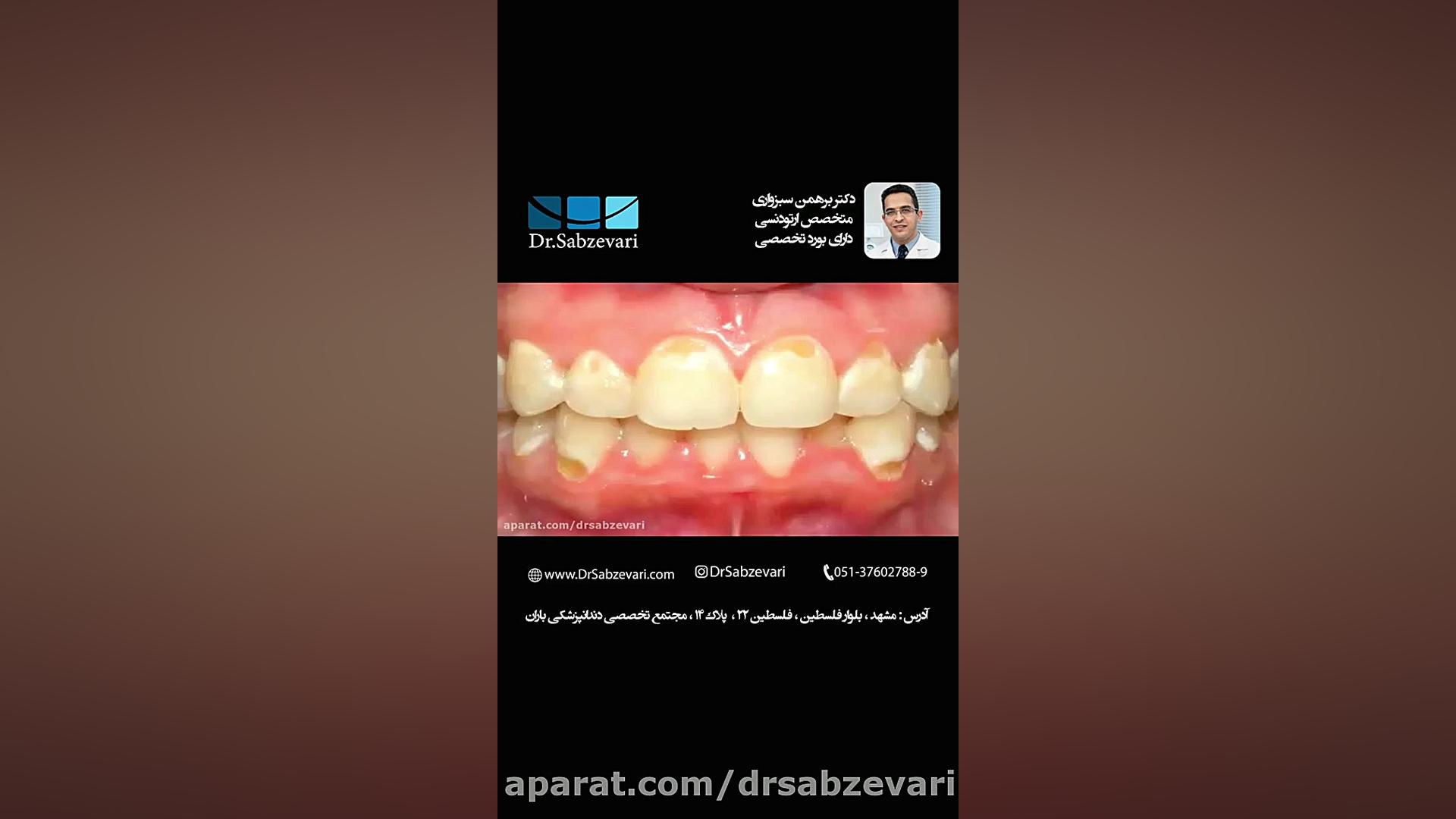 بهداشت دهان در ارتودنسی ثابت (2) دکتر برهمن سبزواری - متخصص ارتودنسی - مشهد
