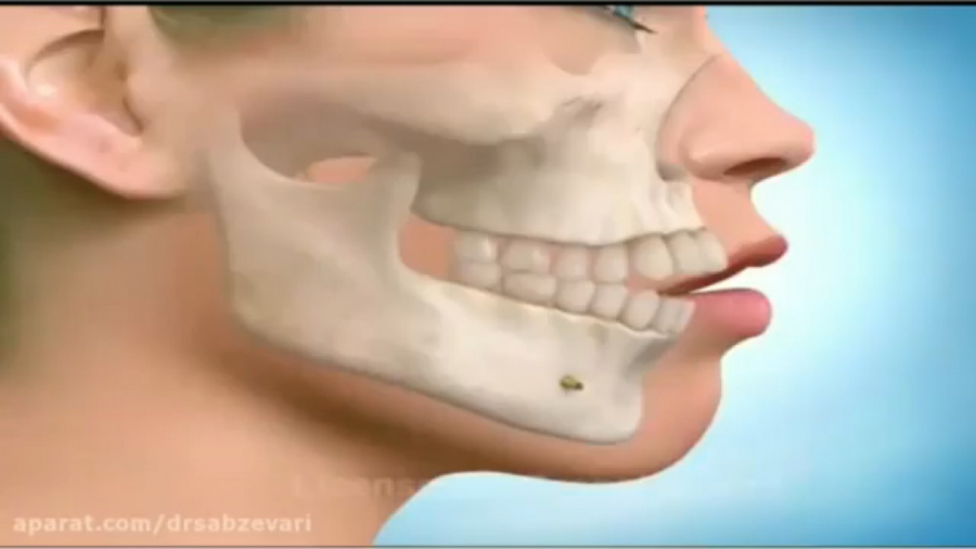 ارتودنسی ثابت و جراحی فک بالا دکتر برهمن سبزواری - متخصص ارتودنسی - مشهد