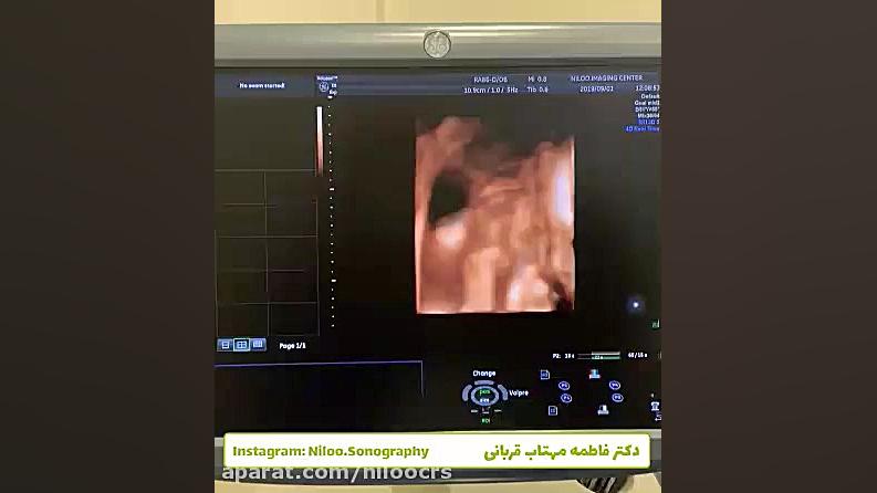 دیابت بارداری سونوگرافی نیلو دکتر فاطمه مهتاب قربانی
