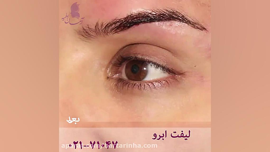 لیفت ابرو در کلینیک آرمان الهیه آزمون سنجش اسید بیلی‌روبین غیرمستقیم