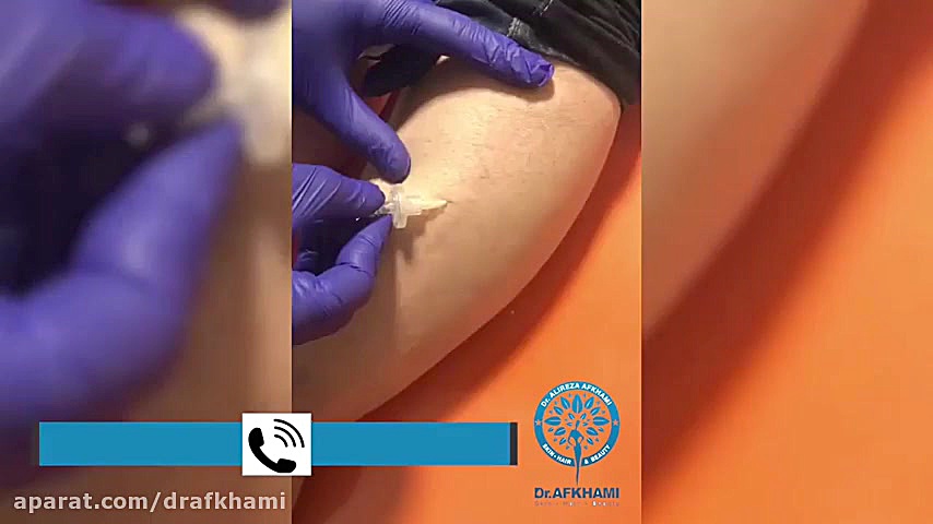 درمان واریس پا با کربوکسی تراپی پالبوسیکلیب