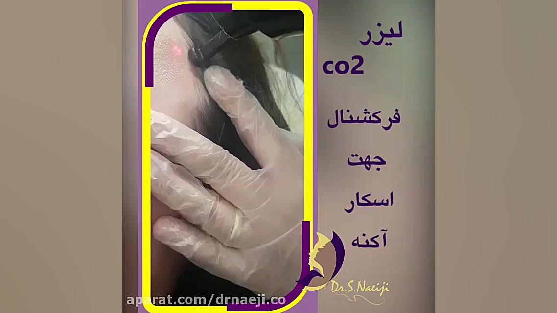 درمان اسکار آکنه با لیزر CO2 فرکشنال دکتر صدیقه نائیجی | متخصص پوست و مو در قم