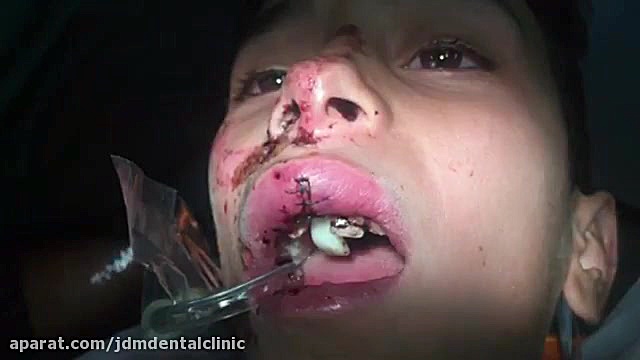 جایگذاری دندان ضربه خورده (تروما) جراحی بینی