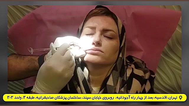 تزریق بوتاکس و فیلر خط خنده | دکتر سینا صفایی کلینیک مو