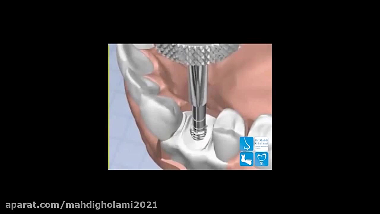 مراحل کاشت ایمپلنت دکتر مهدی غلامی