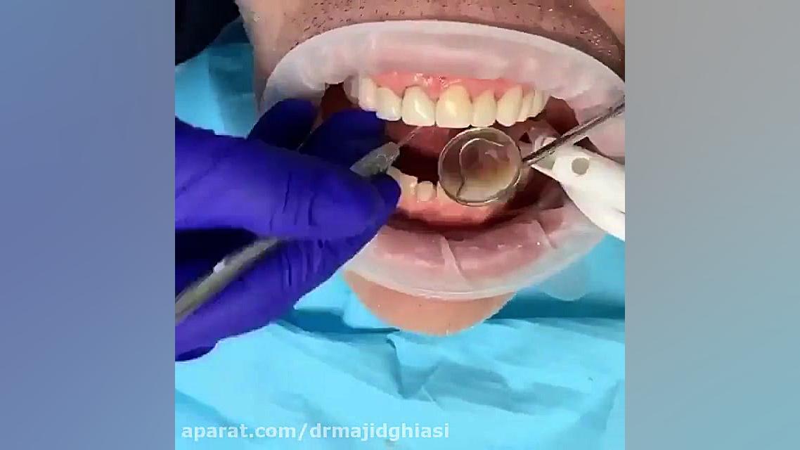 اصلاح طرح لبخند -دکترمجیدقیاسی دندانپزشک زیبایی مشهد دکترمجیدقیاسی