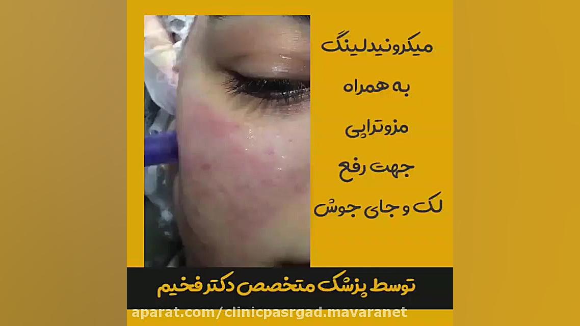 میکرونیدلینگ برای رفع لک و جای جوش میکرونیدلینگ
