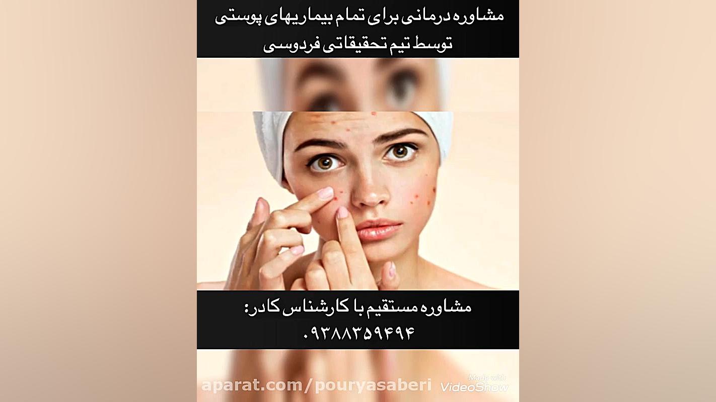 درمان بیماری های پوستی،بیماری پوستی پسوریازیس و بیماری پوستی صدف سیروان خسروی