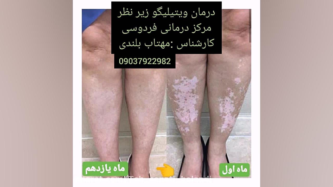 درمان ویتیلیگو زیر نظر متخصص گل گدوت