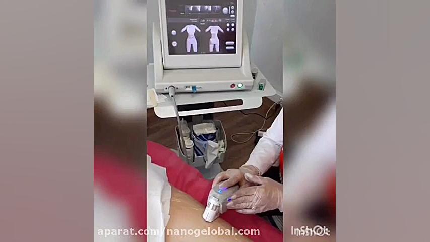 هایفو تراپی برای لاغری و سفت شدن بازو و ران توپوتیکان