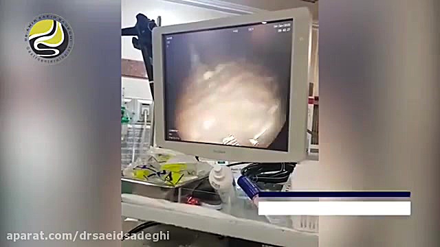 فیلم کولونوسکوپی و نشان دادن عوارض مصرف ملین زاویه سازی صورت