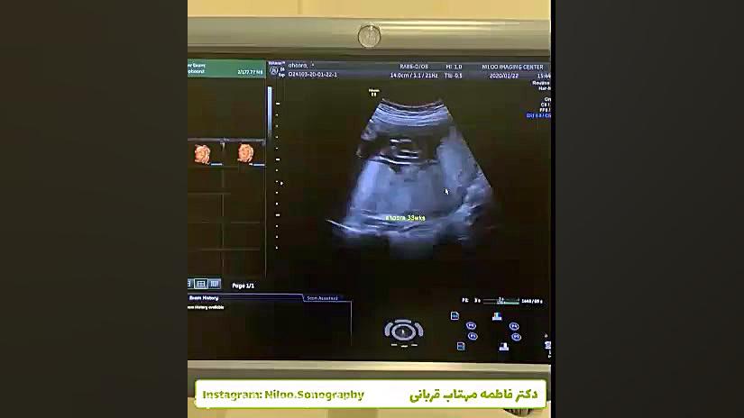 گریدینگ جفت سونوگرافی نیلو دکتر فاطمه مهتاب قربانی