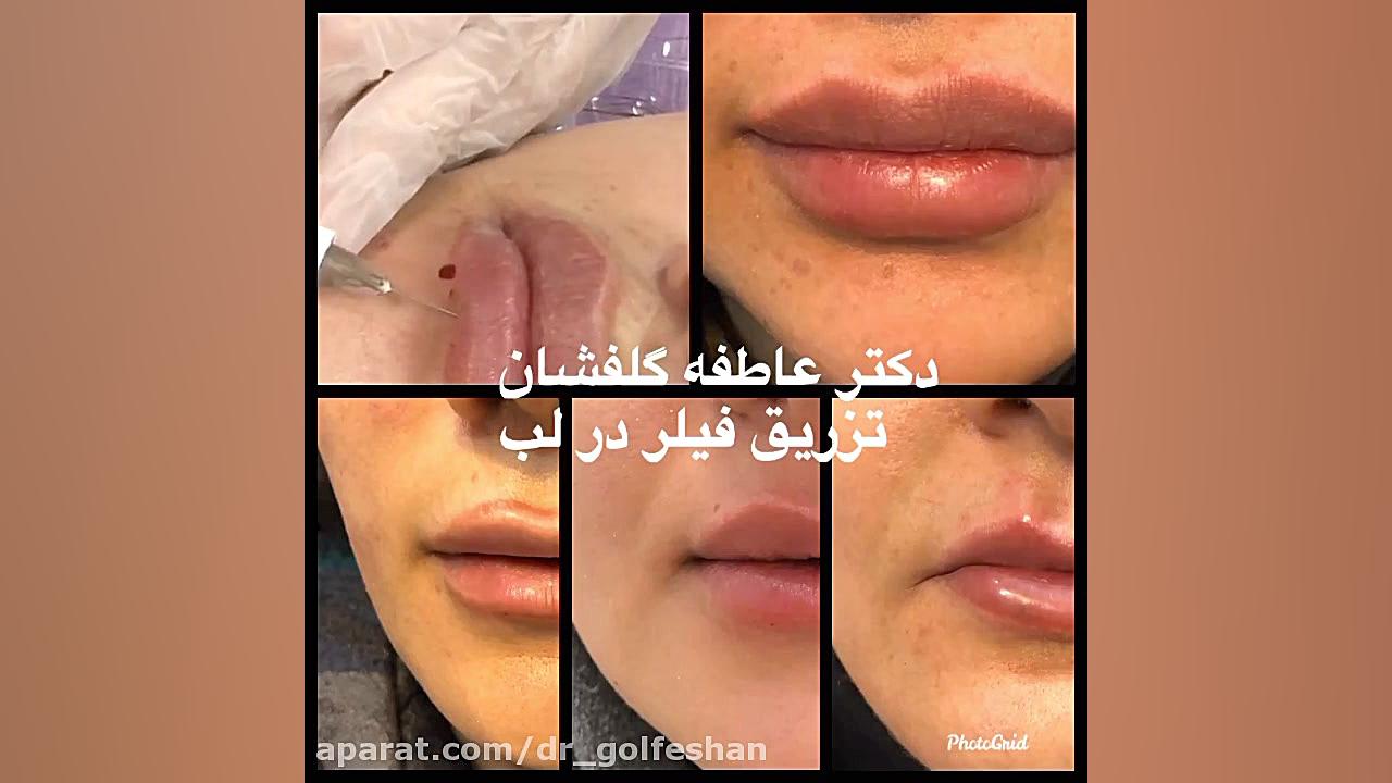 حجمدهی لب با فیلر دکتر عاطفه گلفشان، متخصص پوست مو و لیزر درمانی