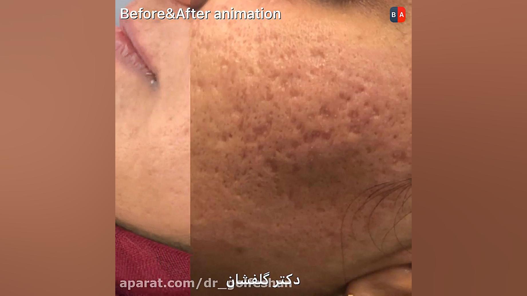 بهبود نسبی اسکار آکنه با یک جلسه سابسیژن و لیزر دکتر عاطفه گلفشان، متخصص پوست مو و لیزر درمانی