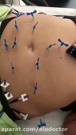 الو دکتر درمان لاغری با لیزر ا...