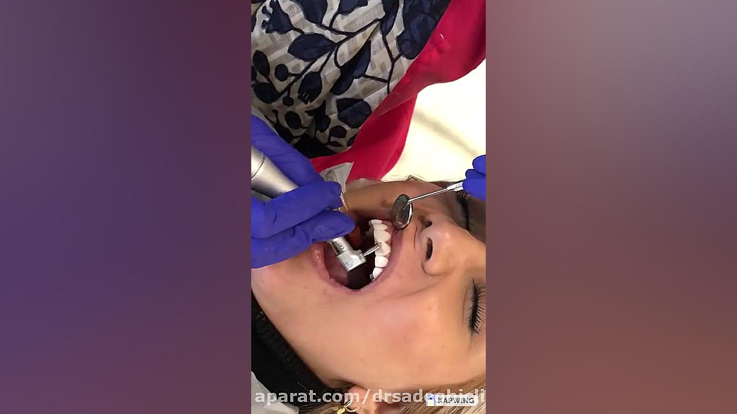 مرحله نهایی پولیش کامپوزیت ونیر امریکایی بیماری تاکایاسو
