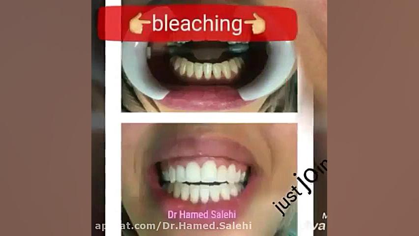 بلیچینگ دندان | دکتر حامد صالحی مهندسی ژنوم انسانی