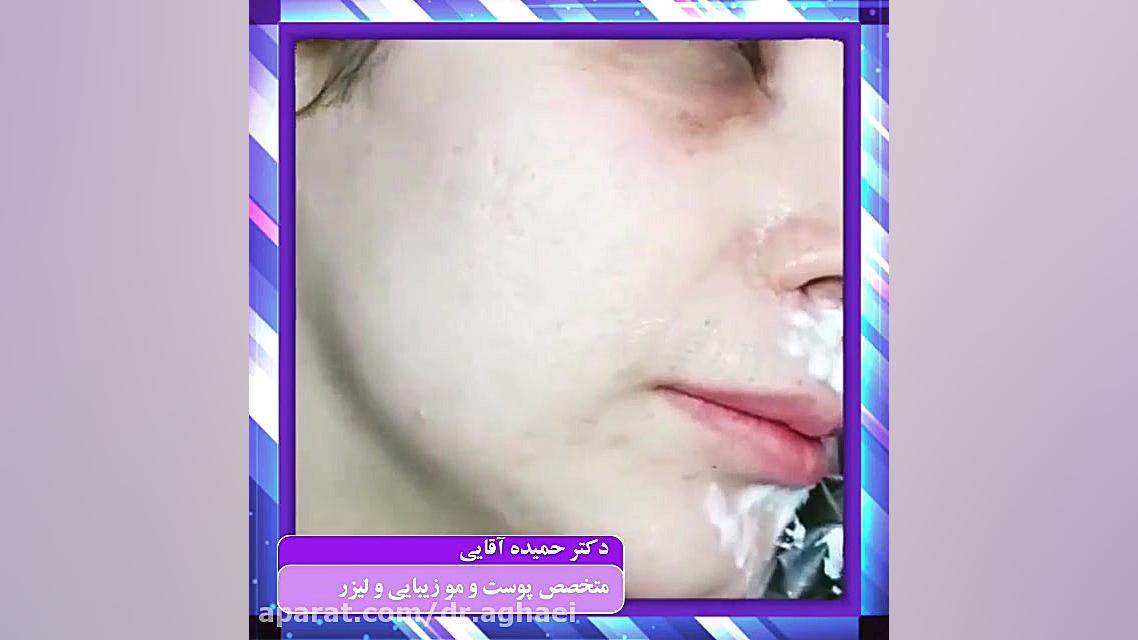 فیلم کربوکسی تراپی زیرچشم دکتر حمیده آقایی