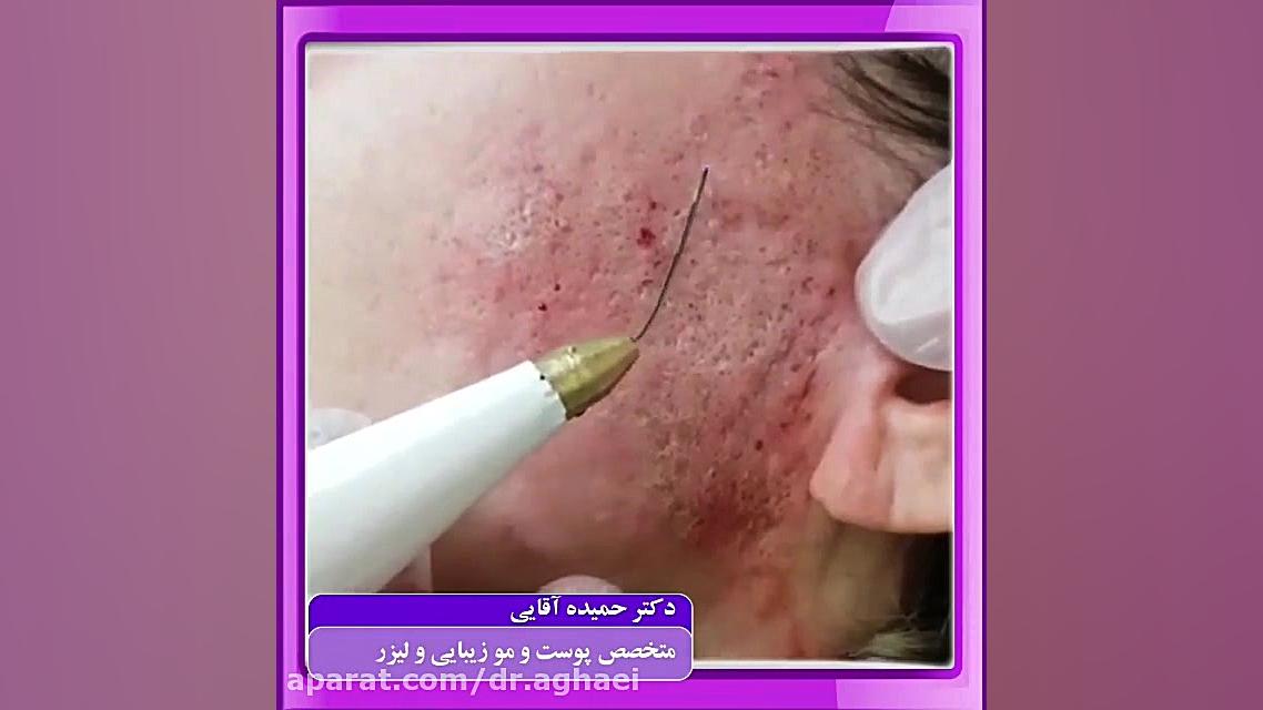پلاسما جت دکتر حمیده آقایی