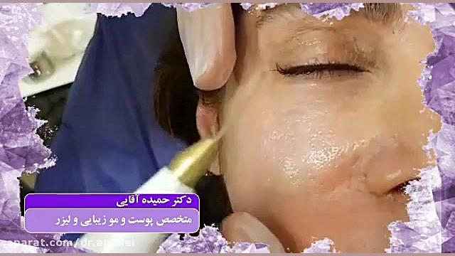 درمان افتادگی پلک با پلاسما جت دکتر حمیده آقایی