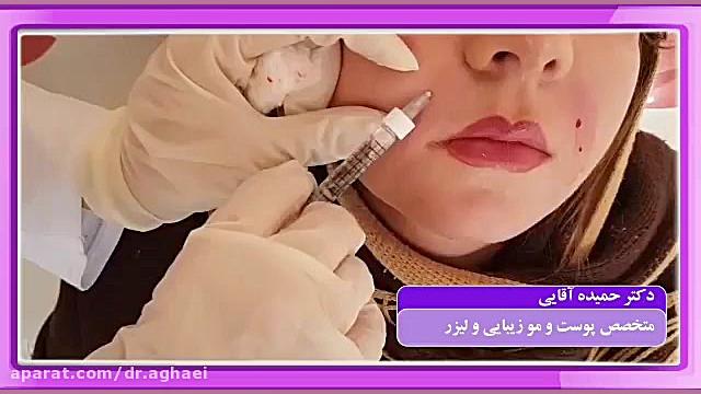 فیلم تزریق ژل خنده دکتر حمیده آقایی