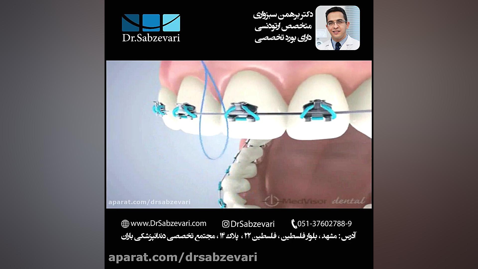 کاربرد نخ دندان در ارتودنسی ثابت ایکلوزوماب
