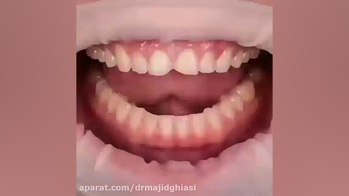 ونیر دندانی-دکترمجیدقیاسی دندانپزشک زیبایی مشهد دکترمجیدقیاسی