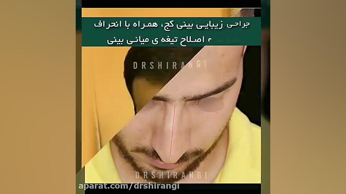 جراحی بینی کج دکتر سعید شیرنگی (فوق تخصص جراحی پلاستیک و زیبایی)