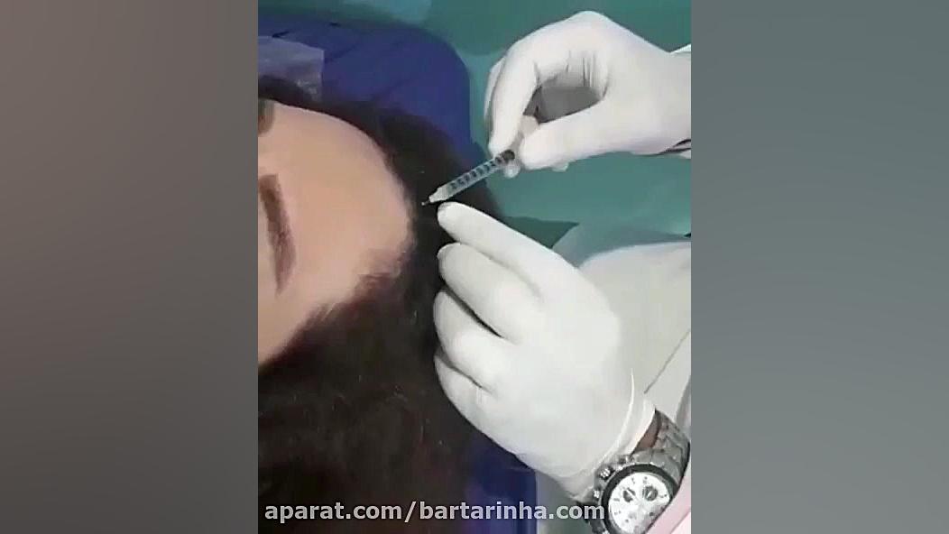 مزوتراپی موی سر در کلینیک زیبایی سلامت ایرانیان کلونیک اسپاسم